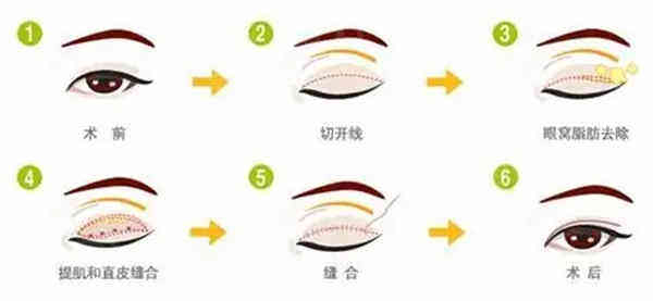 千万别做双眼皮后悔死