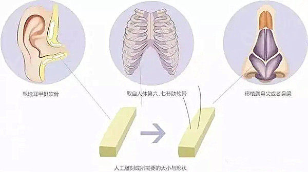自体软骨隆鼻