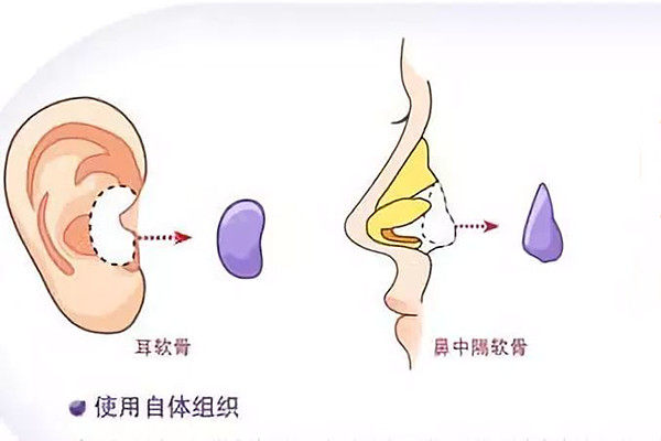 自体软骨隆鼻