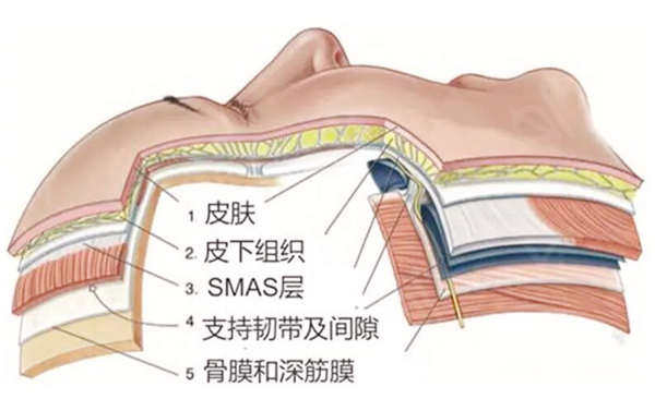 smas筋膜提升手术