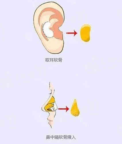 耳软骨和肋骨鼻有什么区别