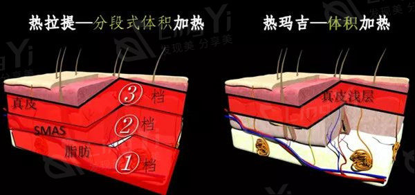 热玛吉和热拉提的区别