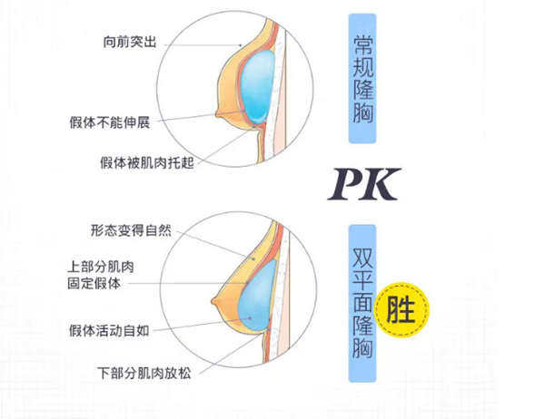 双平面隆胸技术