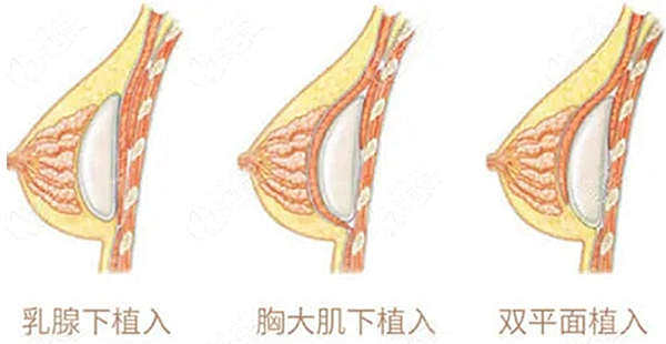 双平面隆胸优点
