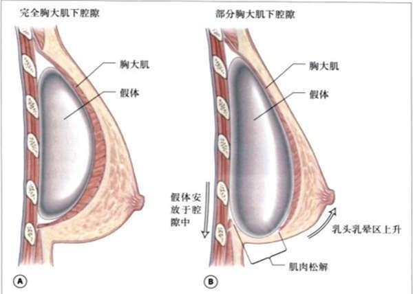 双平面隆胸缺点