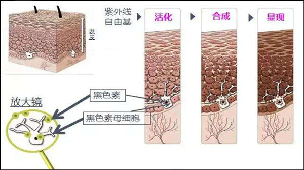 皮秒祛斑会不会反弹