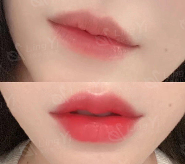 玻尿酸丰唇后