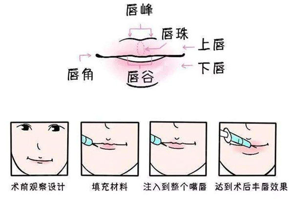 注射玻尿酸