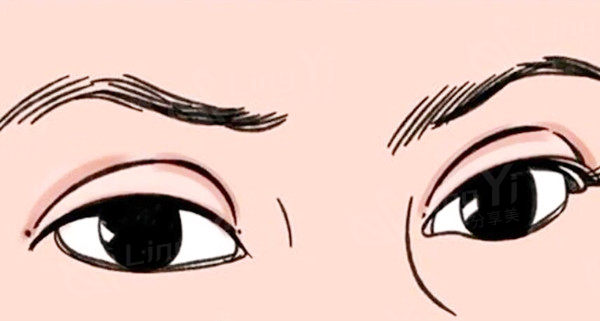 眼部修复手术