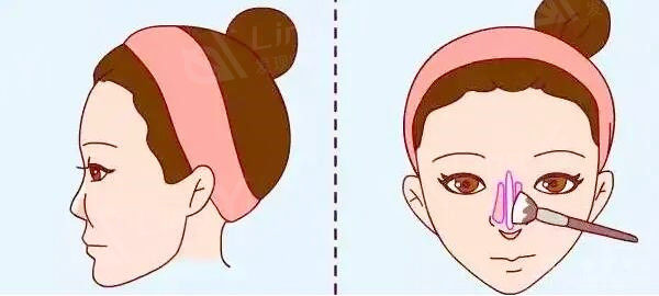 隆鼻手术