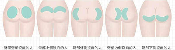 假体丰臀的优点