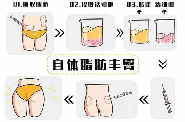 自体脂肪丰臀的缺点