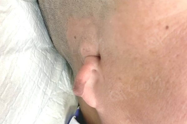 小耳畸形整形手术过程及价格