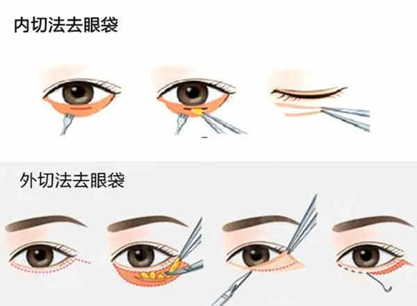 割眼袋手术真的安丨全吗？