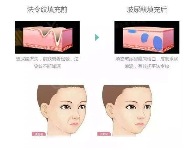 玻尿酸面部填充缺点