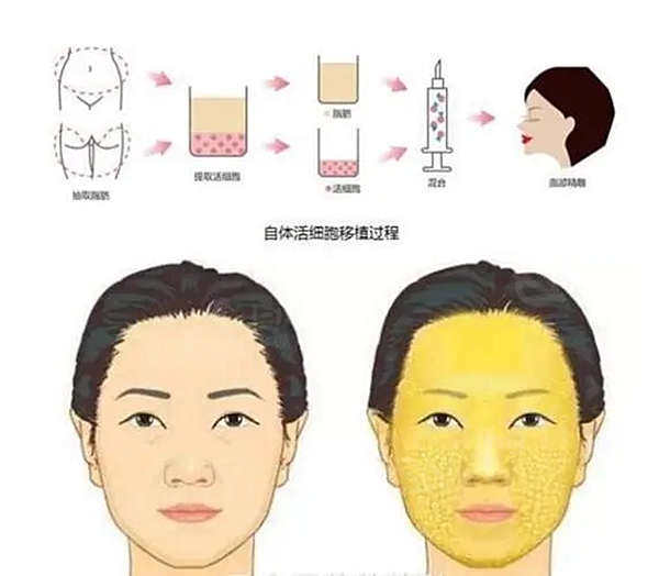 自体脂肪面部填充优点