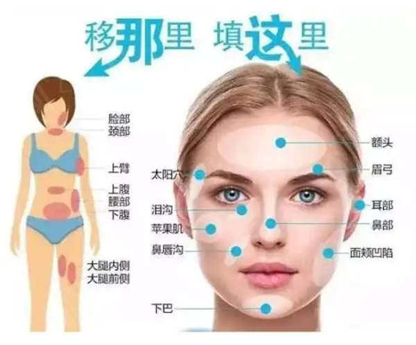 自体脂肪面部填充缺点