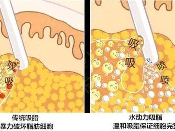 吸脂后多久才能