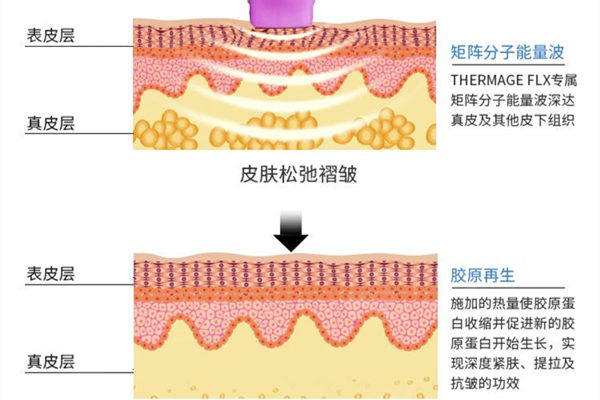 热玛吉四代和五代的区别是什么