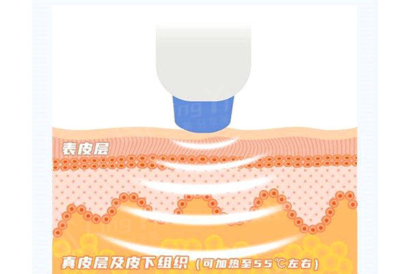 热玛吉四代和五代的区别是什么