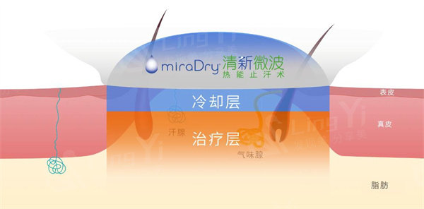 miradry清新微波治疗腋臭