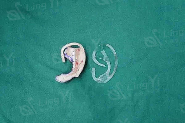 耳再造手术能和正常的一样吗