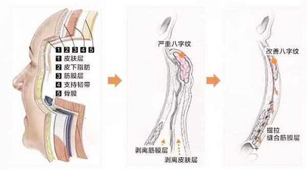 45岁适合做小拉皮还是大拉皮