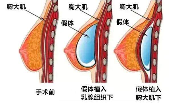 自体脂肪隆胸和假体隆胸哪个好