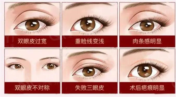 双眼皮肉条感明显