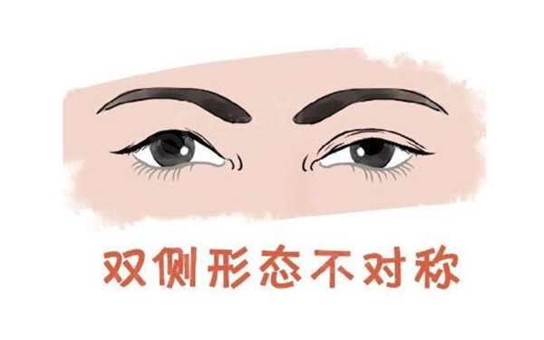 双眼皮左右不对称
