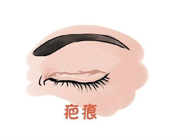 双眼皮疤痕明显