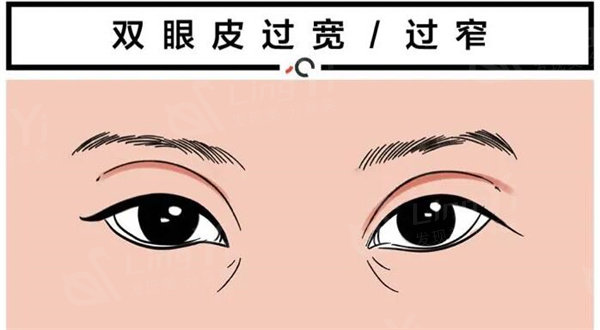 双眼皮疤痕明显