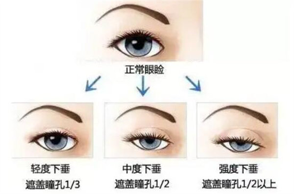 双眼皮睁不开眼