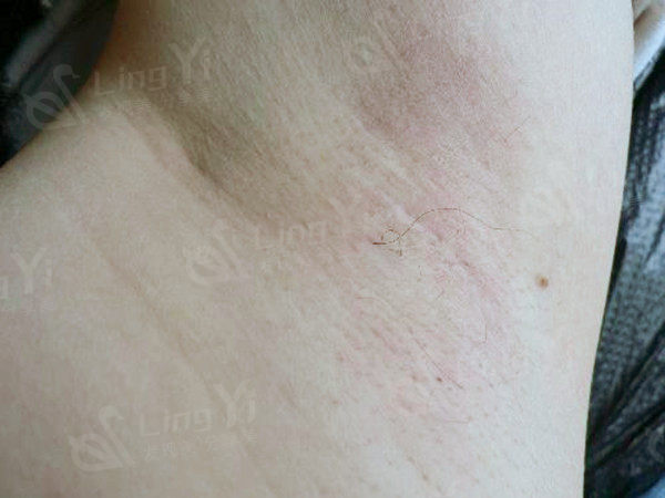 德国VISA显微消融术去腋臭
