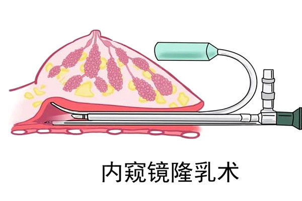 内窥镜隆胸和普通隆胸有什么区别