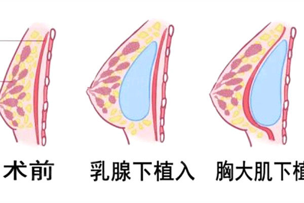 内窥镜隆胸和普通隆胸有什么区别