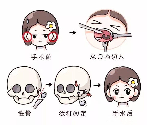 颧骨整形手术示意图