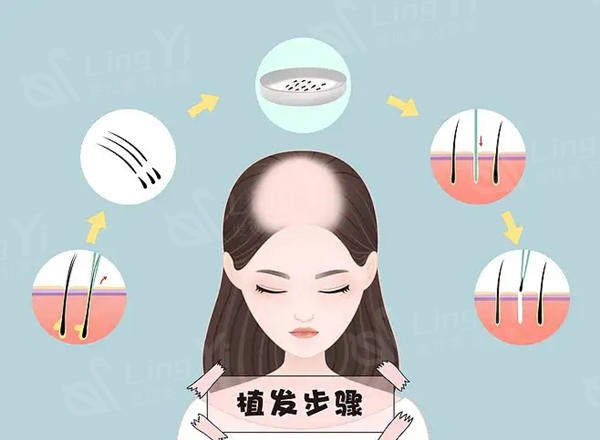 植发