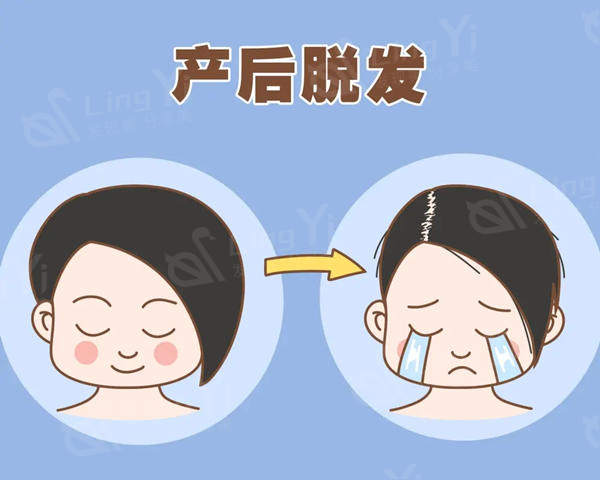为什么会出现产后大量脱发