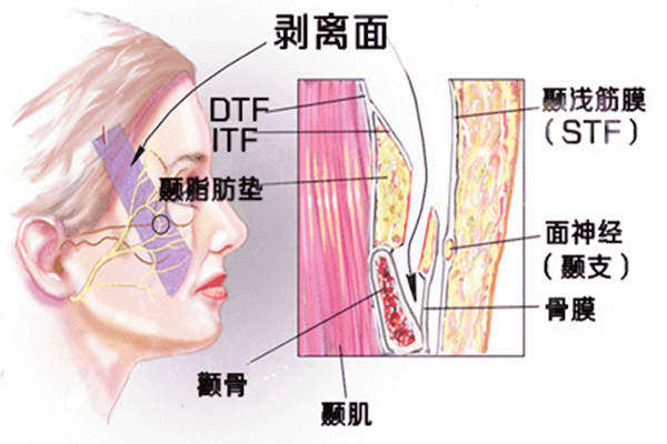 全面部提拉术