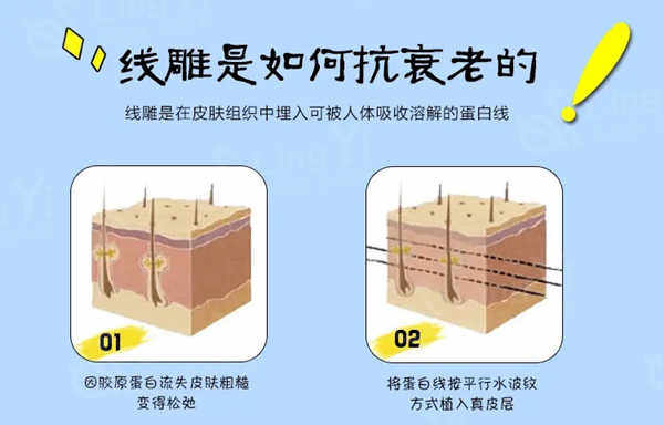 面部提升