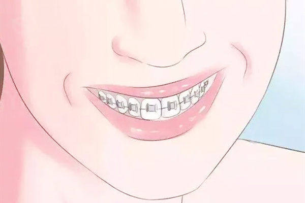 戴牙套引起颧骨外扩会吗