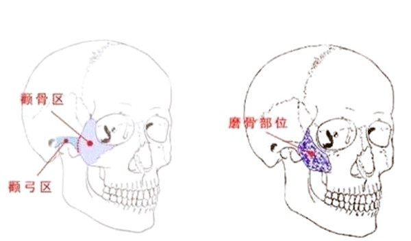 戴牙套从瓜子脸变方脸怎么办-颧骨整形