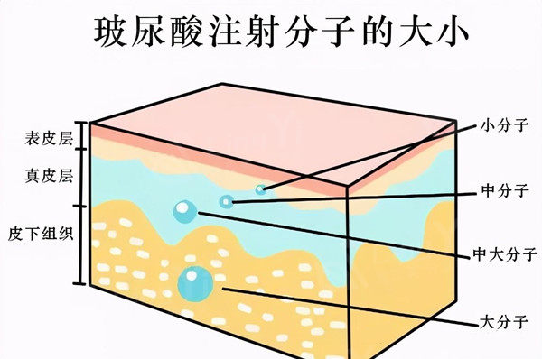 打玻尿酸真的会僵吗