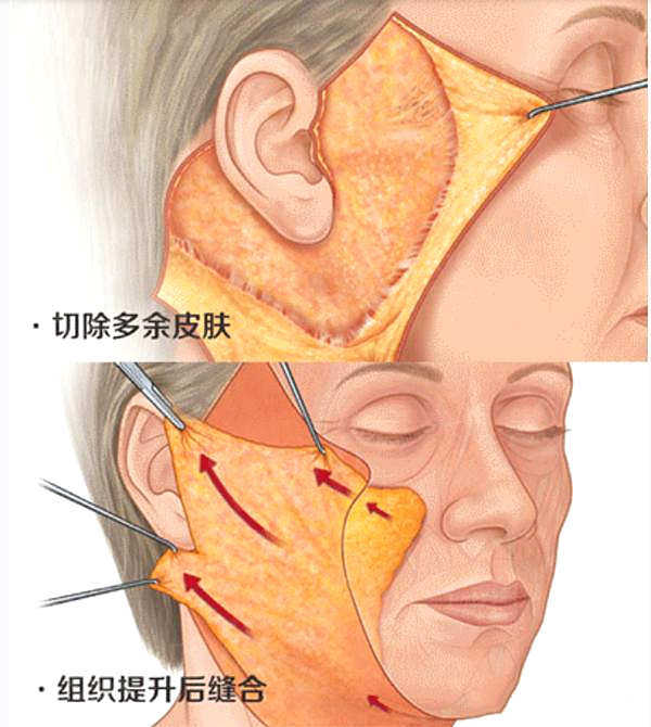 大拉皮与小拉皮的区别是什么