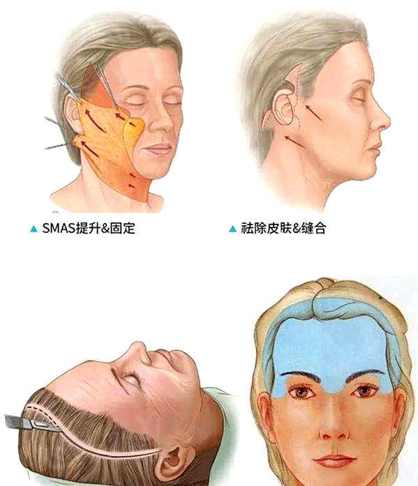 大拉皮与小拉皮的区别是什么
