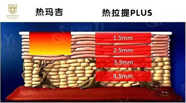 热拉提跟热玛吉的区别