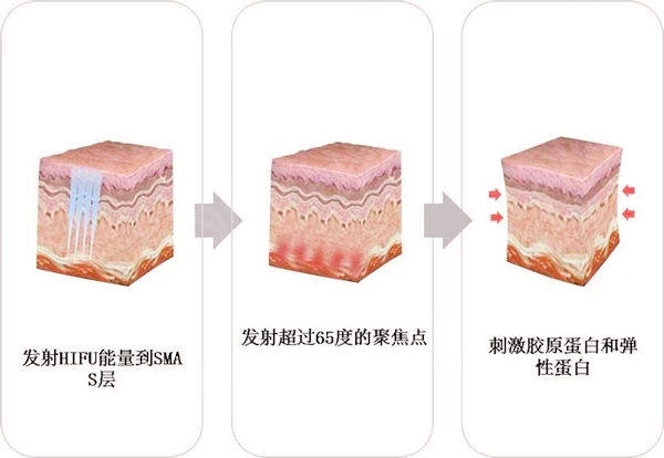 热拉提和热玛吉可以同时做吗