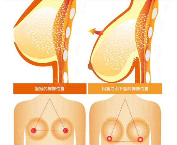 胸部提升手术怎么做