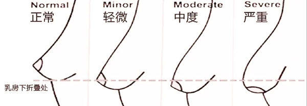 胸部提升手术大概多少钱